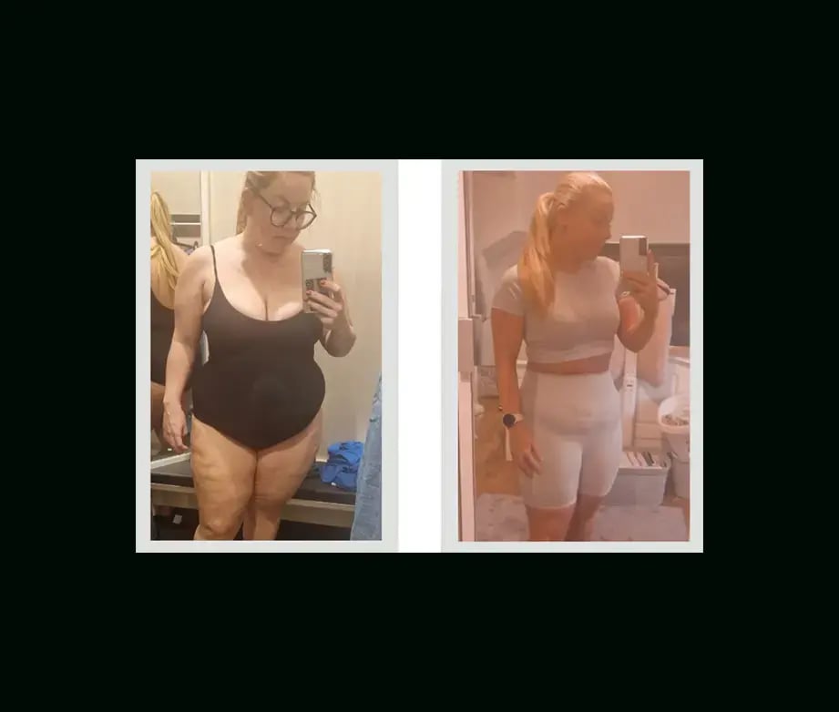 apera-gastric-sleeve-before-after-53