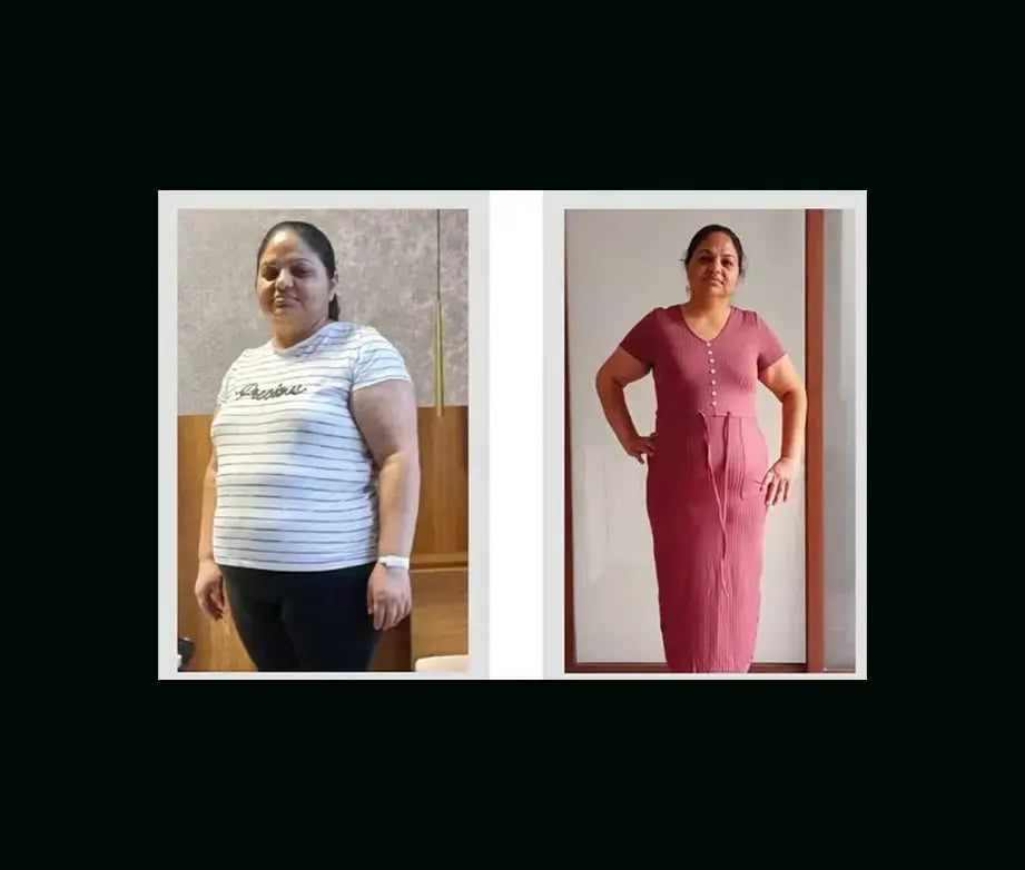 apera-gastric-sleeve-before-after-54