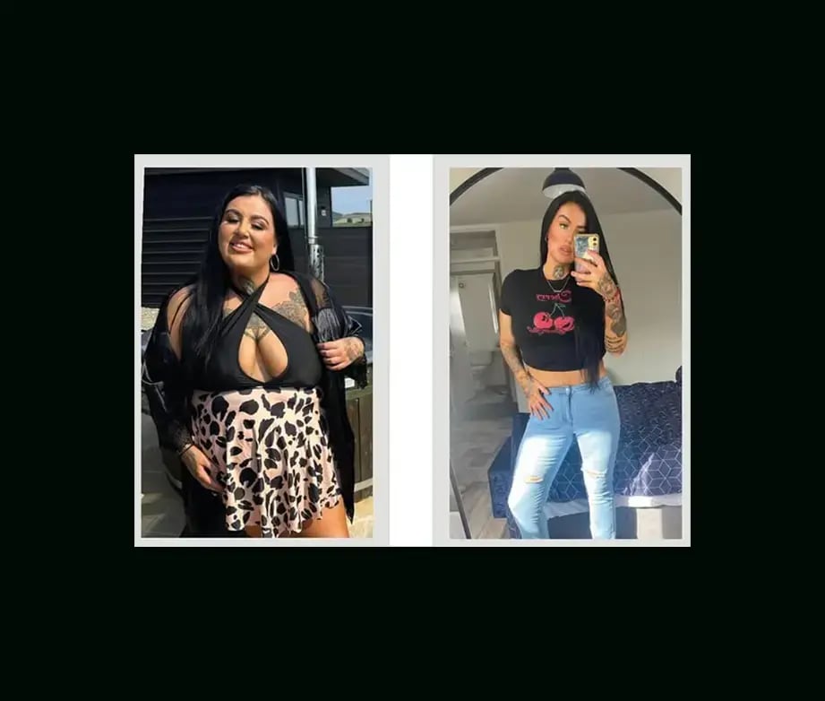 apera-gastric-sleeve-before-after-56