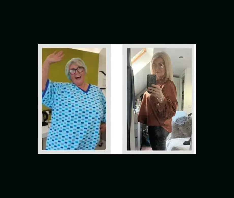 apera-gastric-sleeve-before-after-57