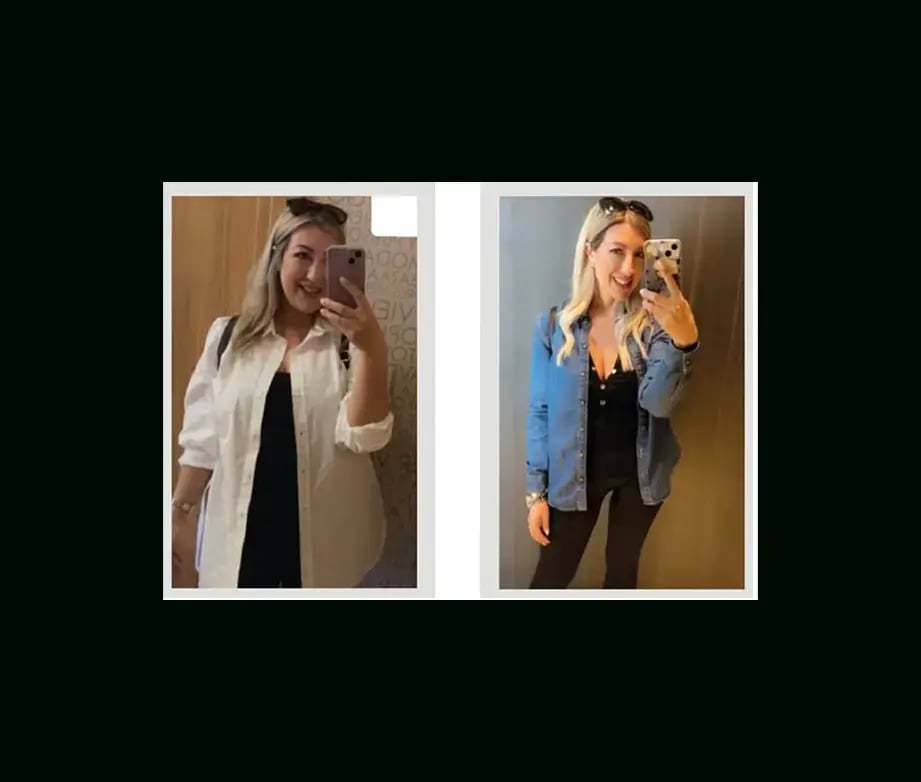 apera-gastric-sleeve-before-after-58