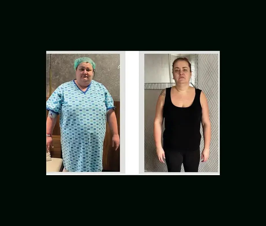 apera-gastric-sleeve-before-after-59