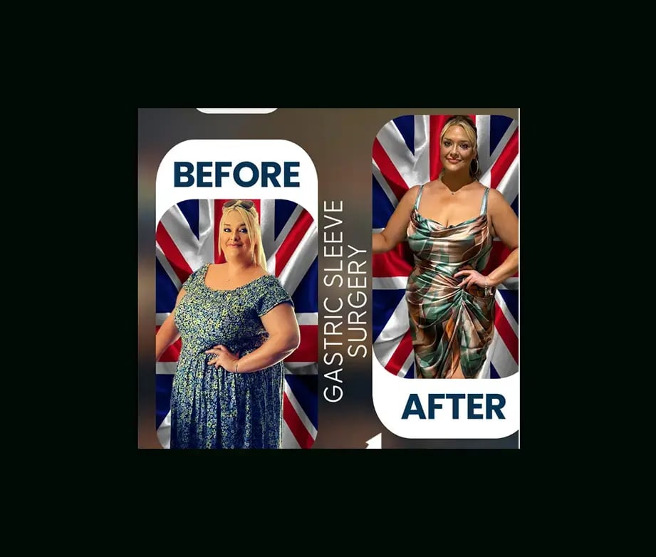 apera-gastric-sleeve-before-after-6