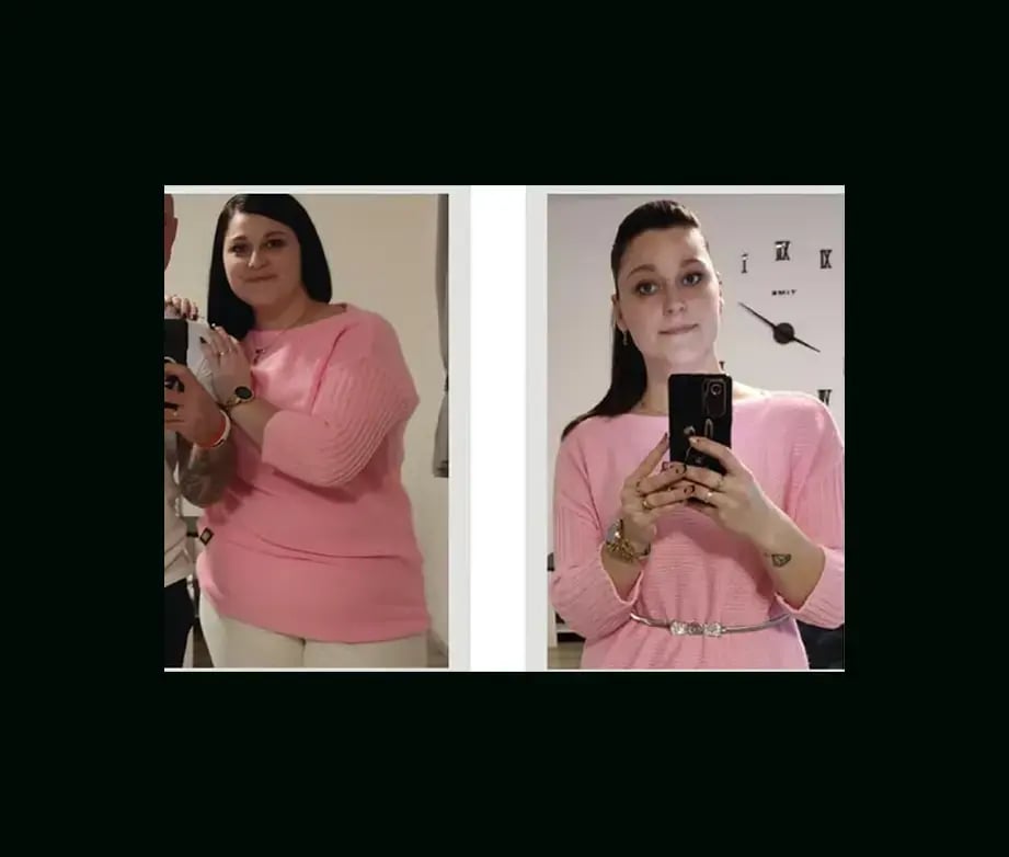apera-gastric-sleeve-before-after-60