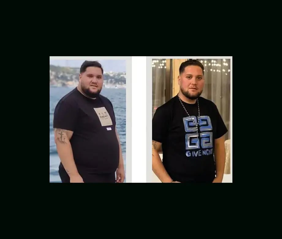 apera-gastric-sleeve-before-after-61
