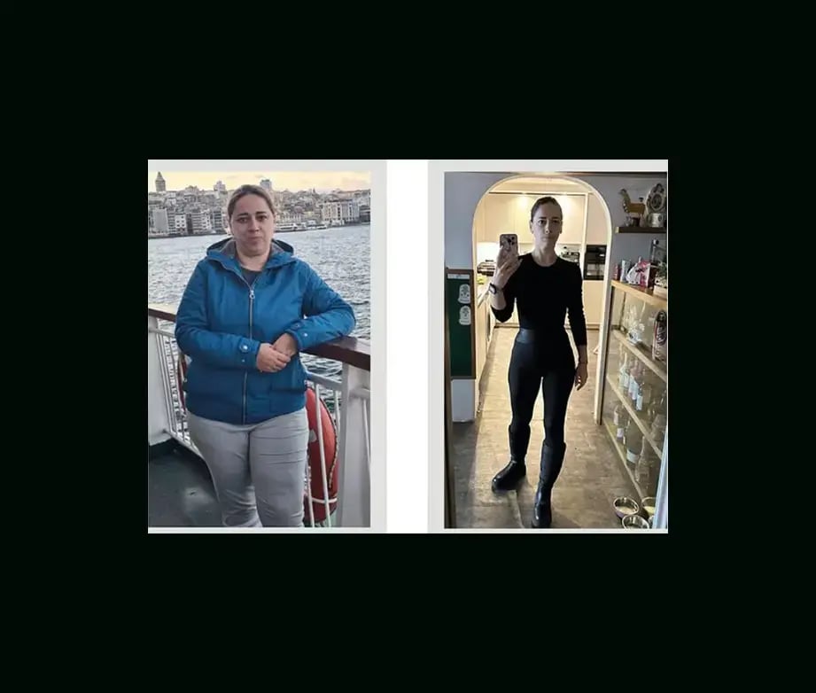 apera-gastric-sleeve-before-after-62