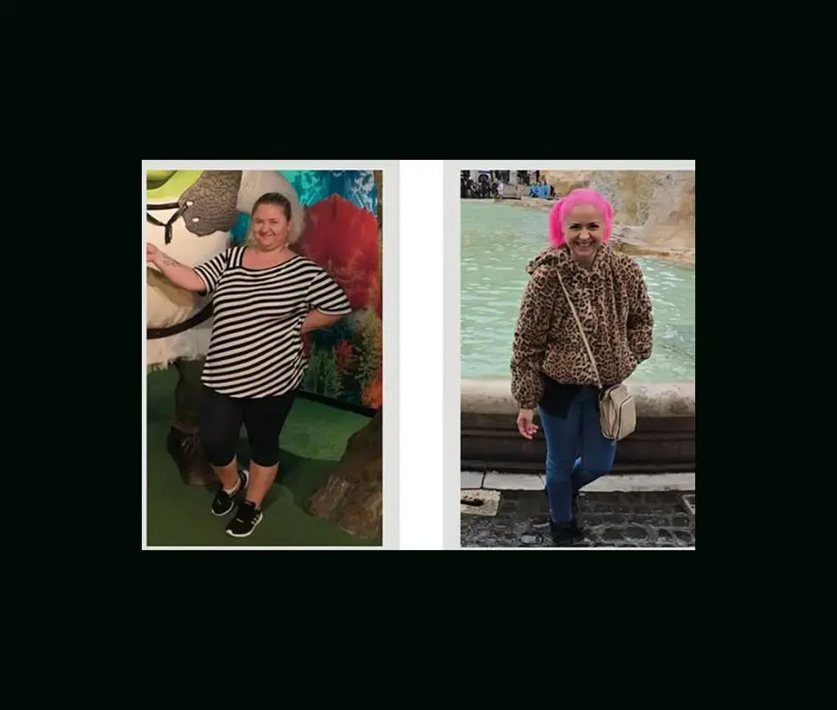 apera-gastric-sleeve-before-after-63