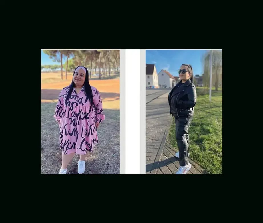 apera-gastric-sleeve-before-after-64
