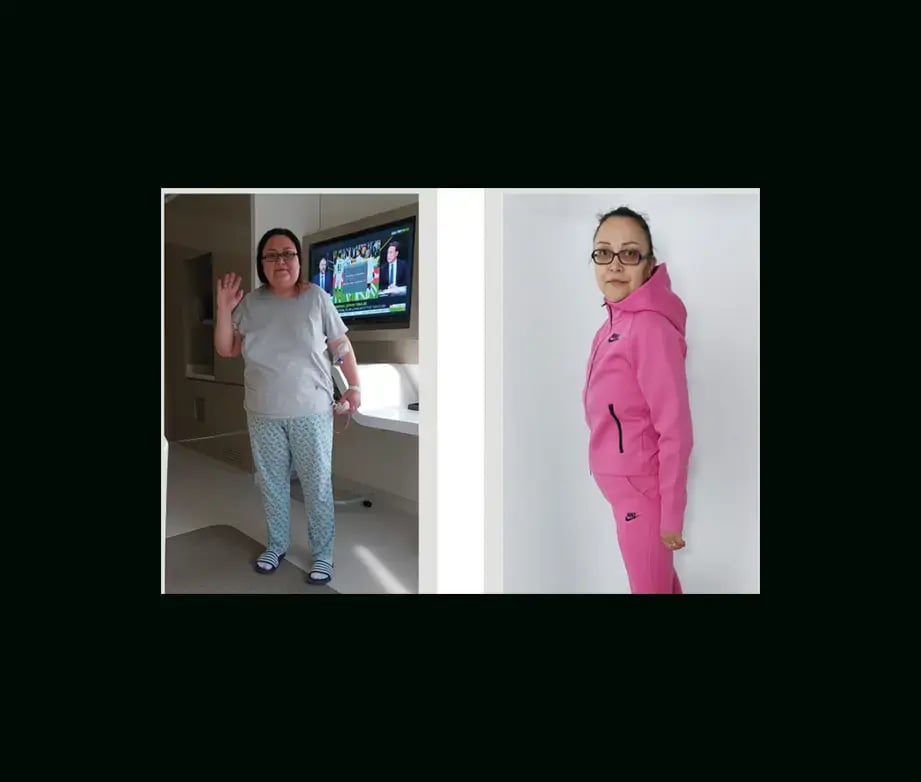 apera-gastric-sleeve-before-after-65