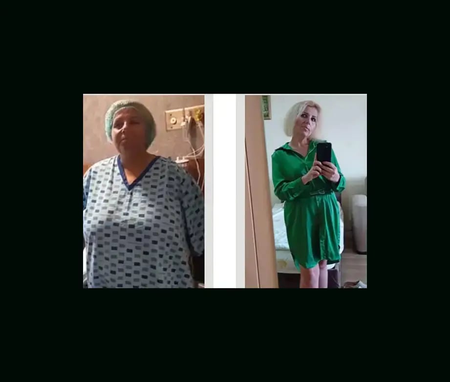 apera-gastric-sleeve-before-after-66
