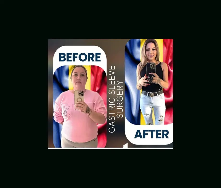 apera-gastric-sleeve-before-after-8