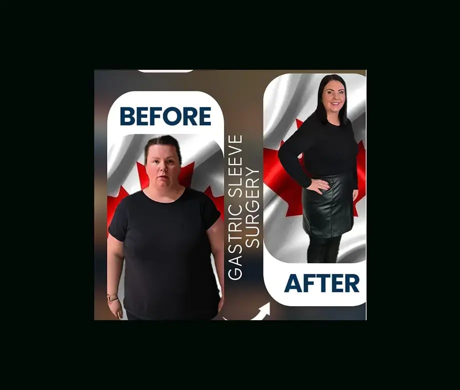 apera-gastric-sleeve-before-after-9