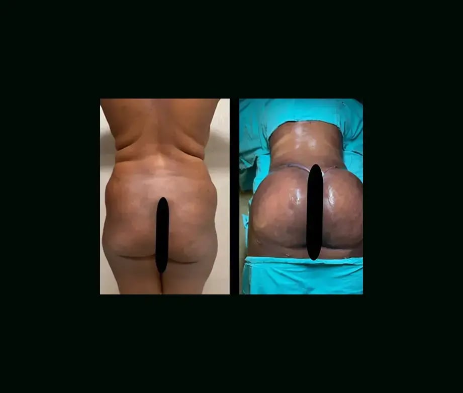 ayberk-akcay-md-bbl-before-after-1-1