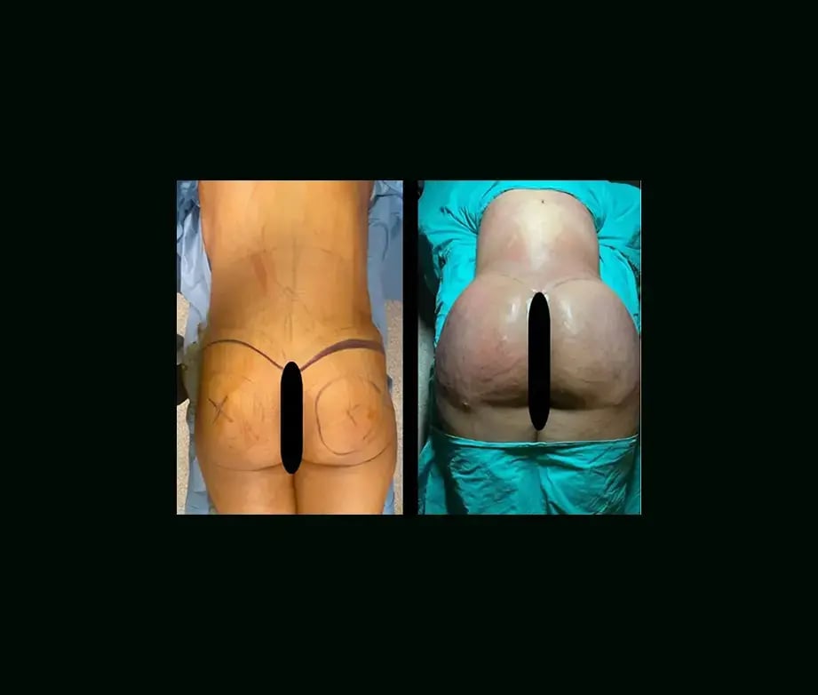 ayberk-akcay-md-bbl-before-after-11