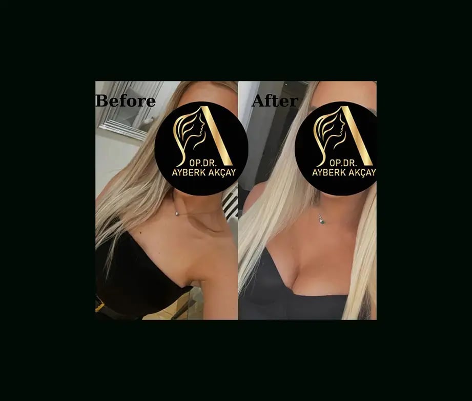 ayberk-akcay-md-breast-augmentation-before-after-1-1