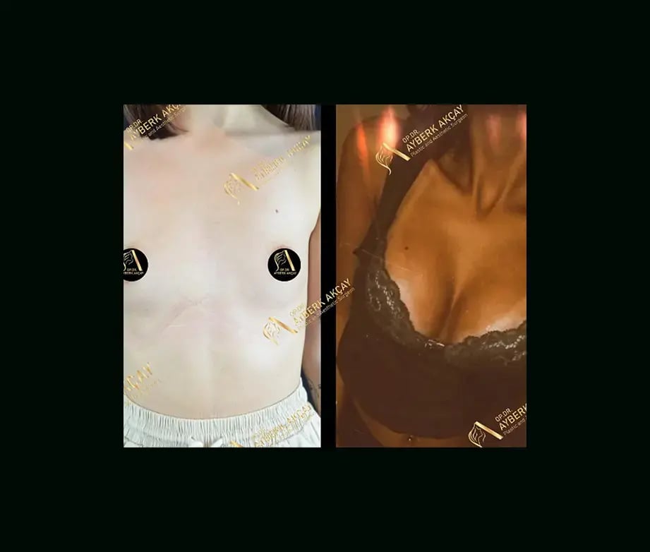 ayberk-akcay-md-breast-augmentation-before-after-2-2