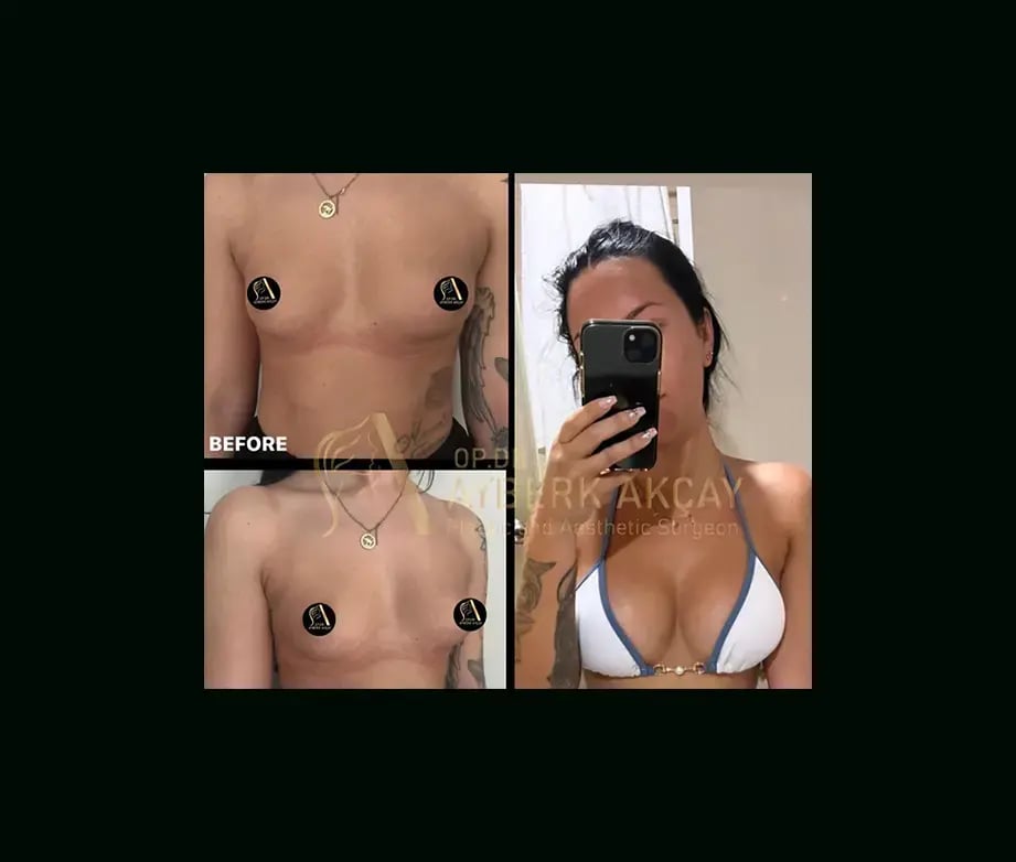 ayberk-akcay-md-breast-augmentation-before-after-4-1