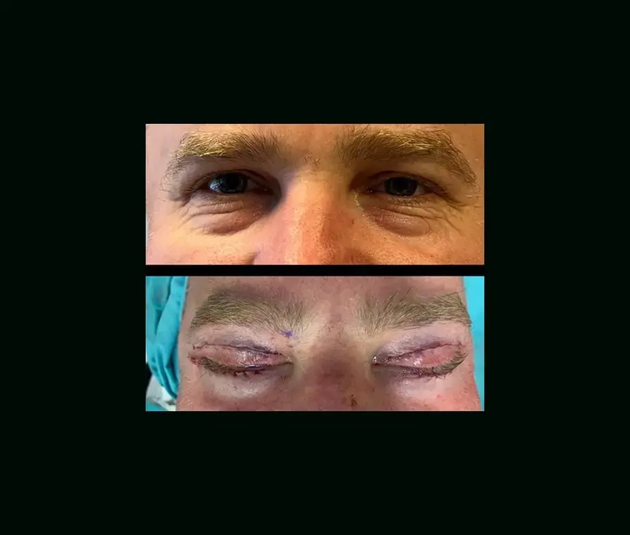 ayberk-akcay-md-eyelid-before-after-1-1