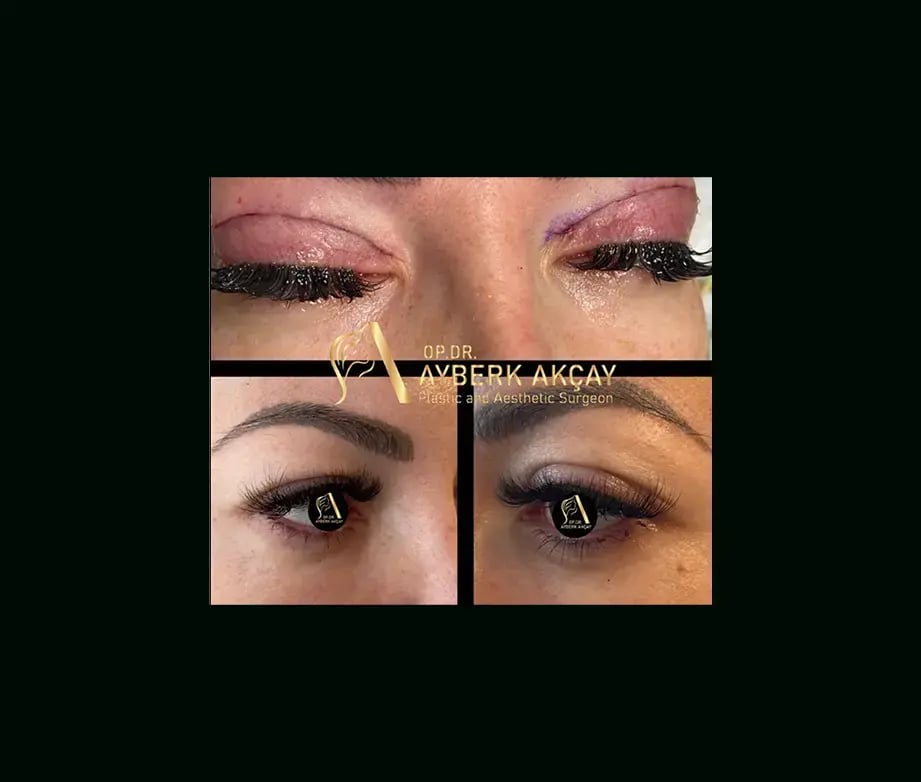 ayberk-akcay-md-eyelid-before-after-2-2