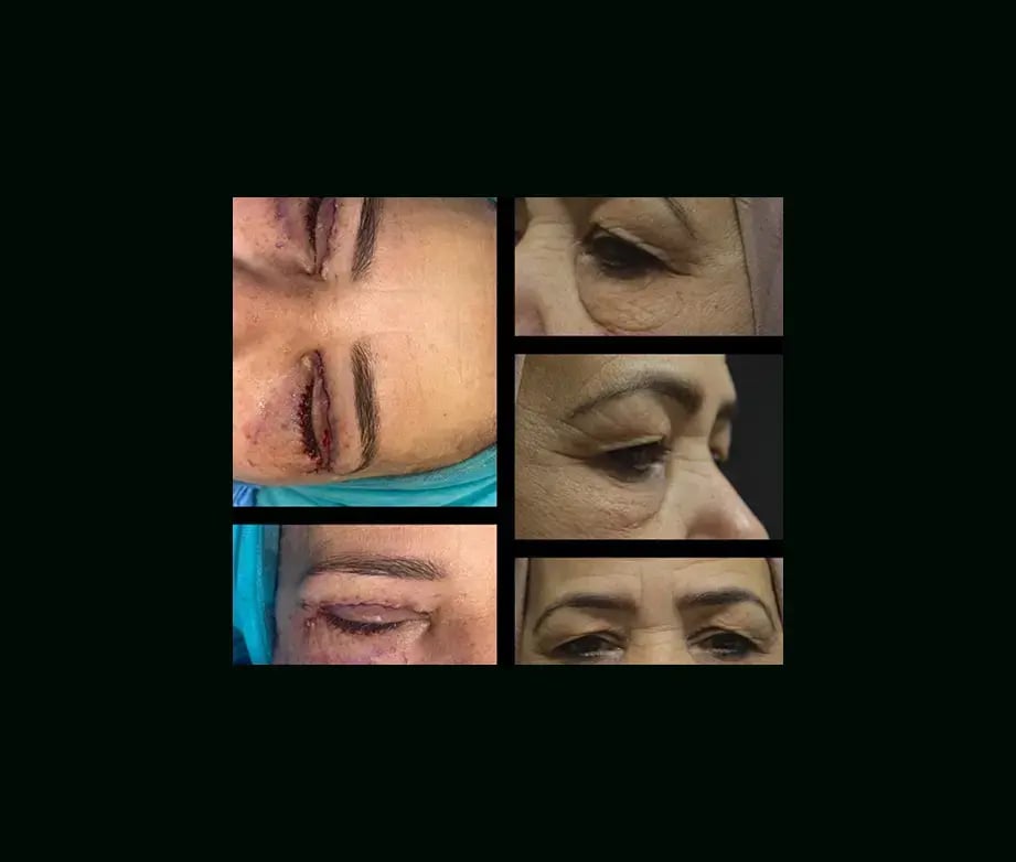 ayberk-akcay-md-eyelid-before-after-3-1
