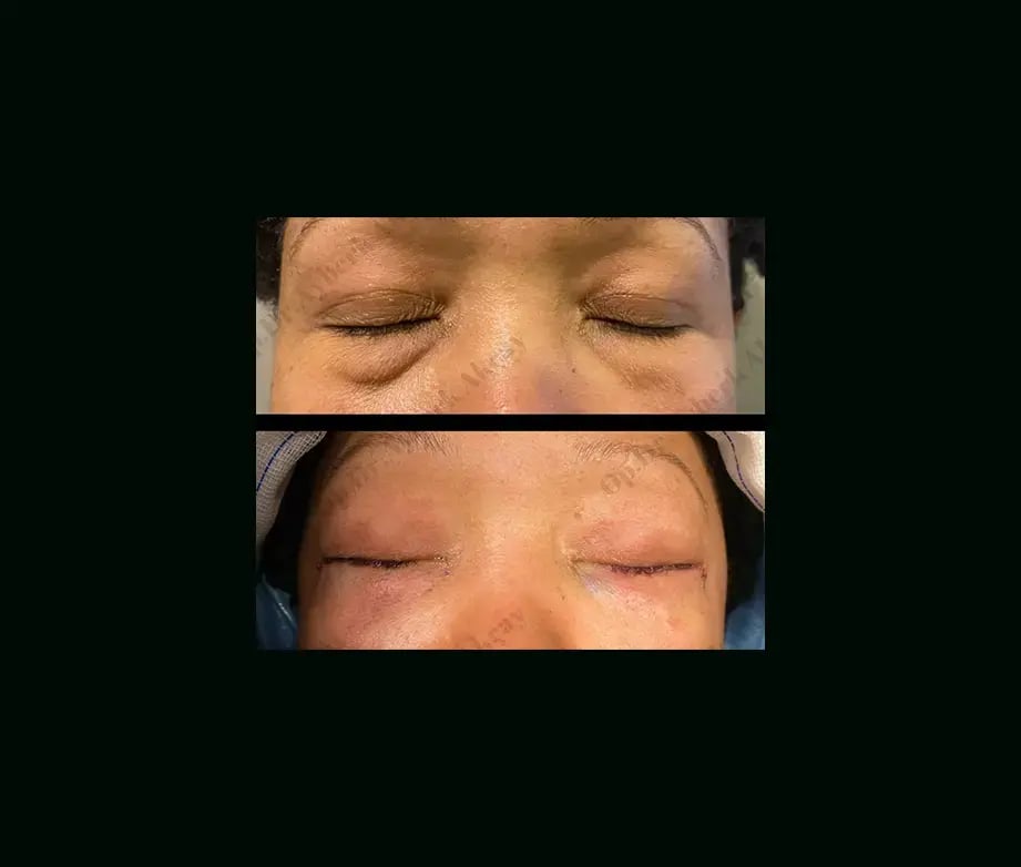 ayberk-akcay-md-eyelid-before-after-4-1