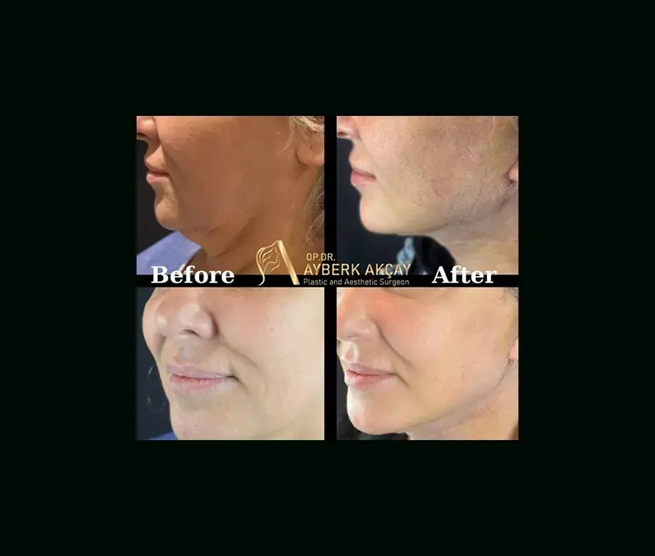 ayberk-akcay-md-face-lift-before-after-1-2