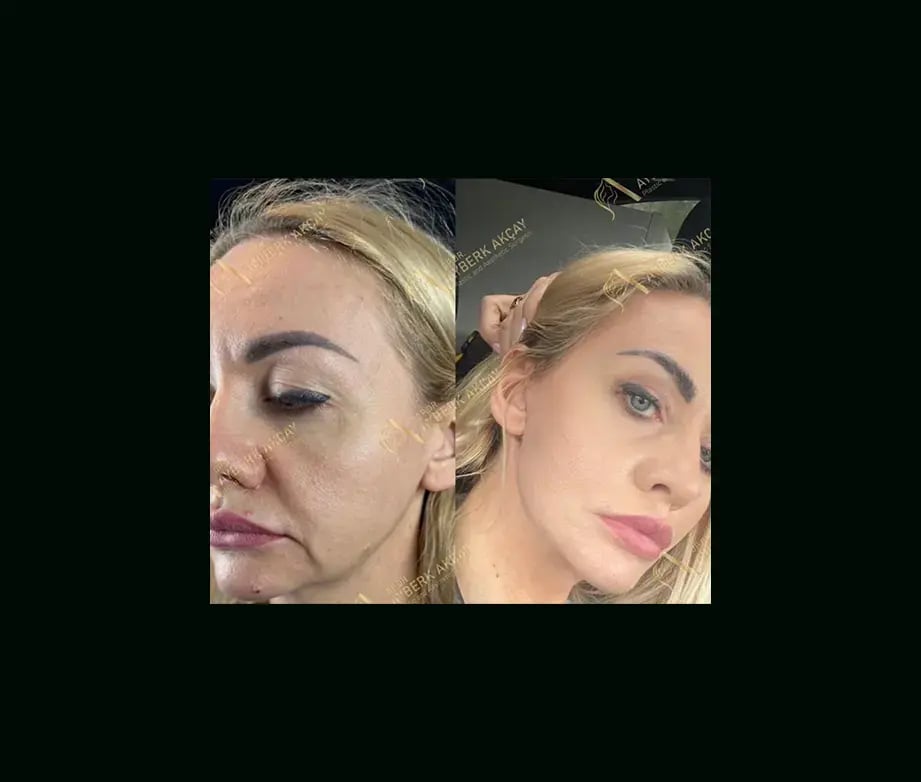 ayberk-akcay-md-face-lift-before-after-2-2
