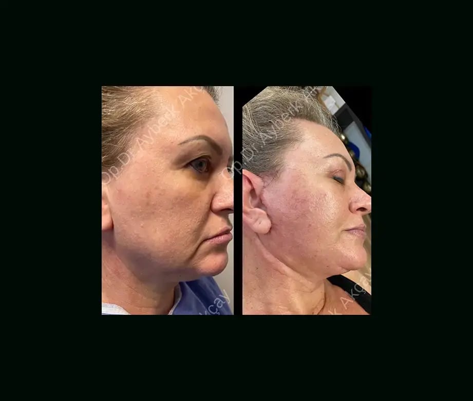 ayberk-akcay-md-face-lift-before-after-3-2