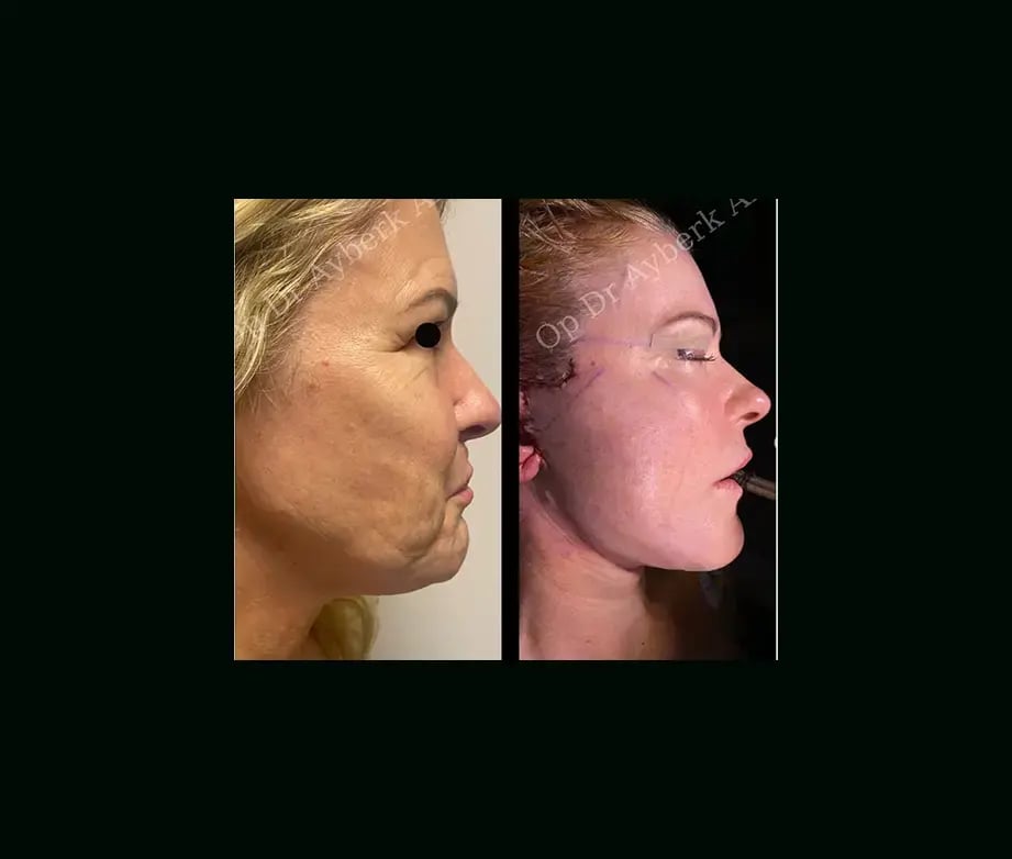 ayberk-akcay-md-face-lift-before-after-4-2