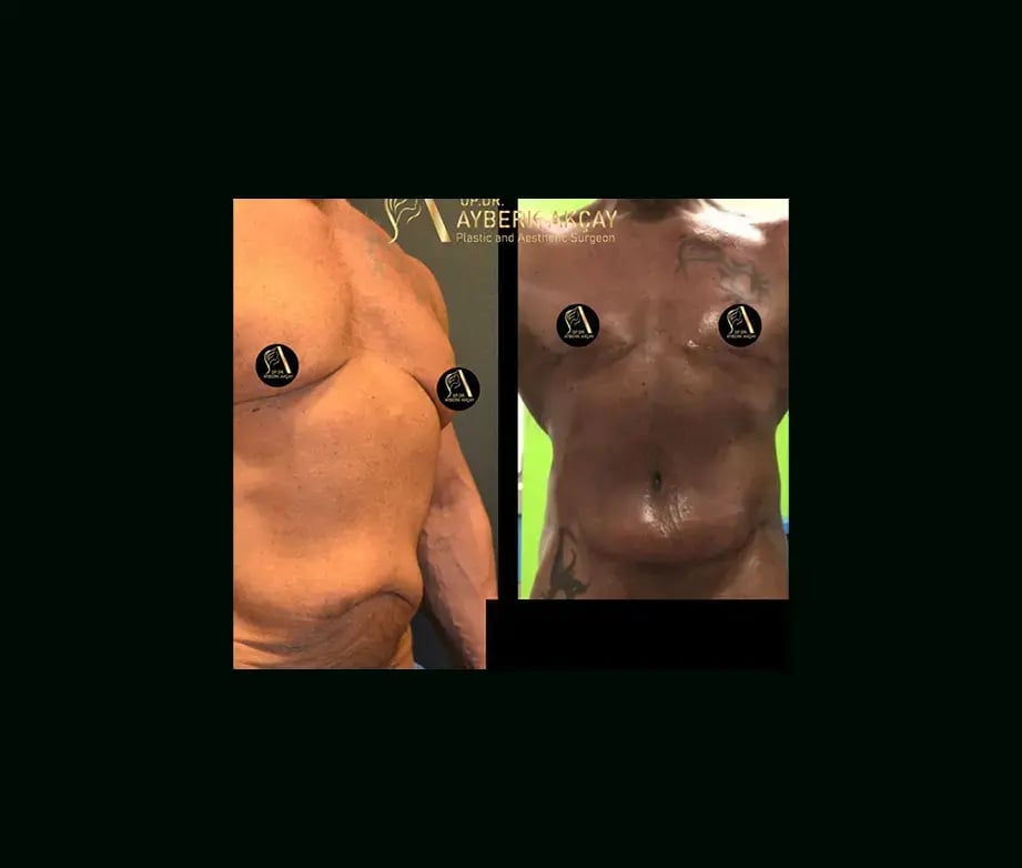 ayberk-akcay-md-liposuction-before-after-1-1