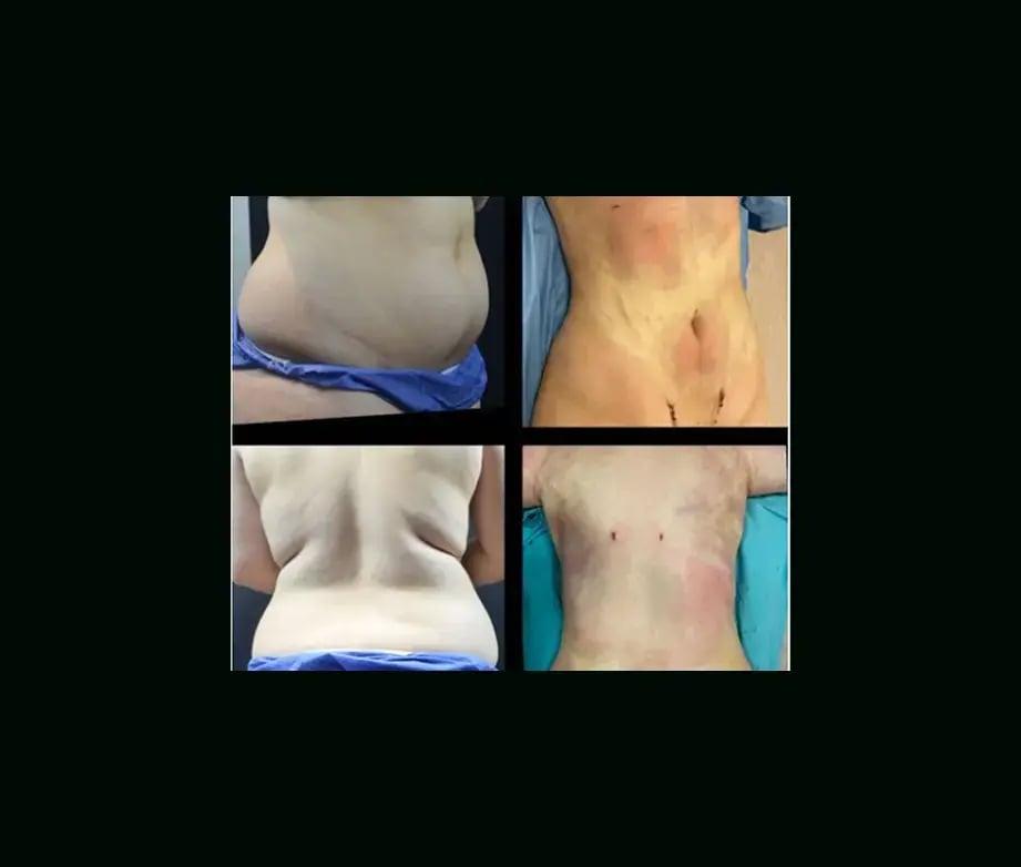 ayberk-akcay-md-liposuction-before-after-2-2