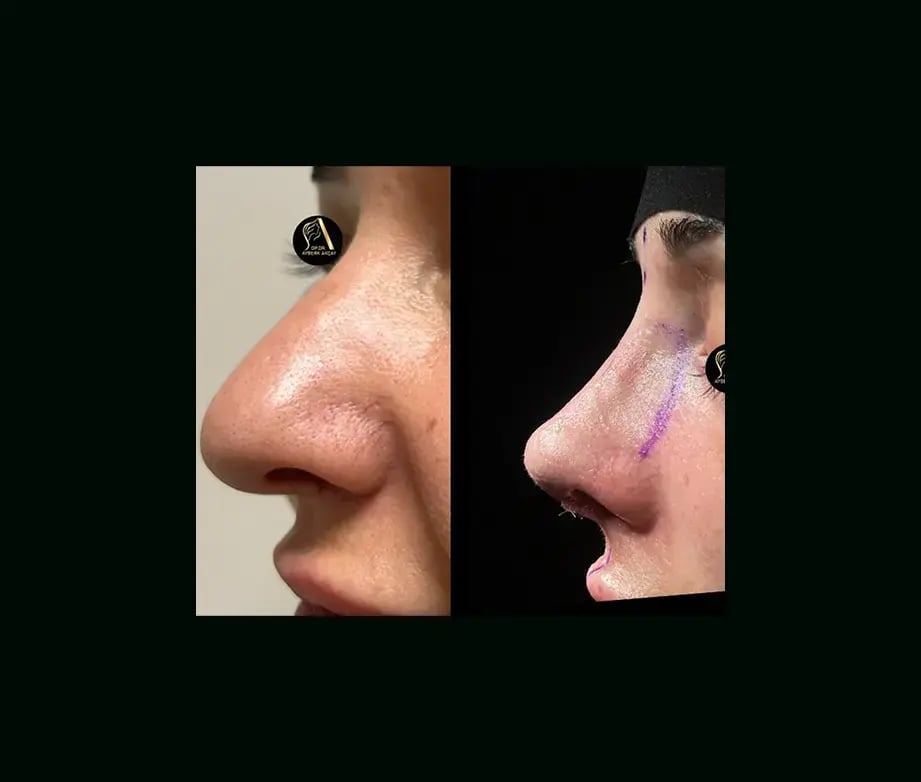 ayberk-akcay-md-rhinoplasty-before-after-1-1