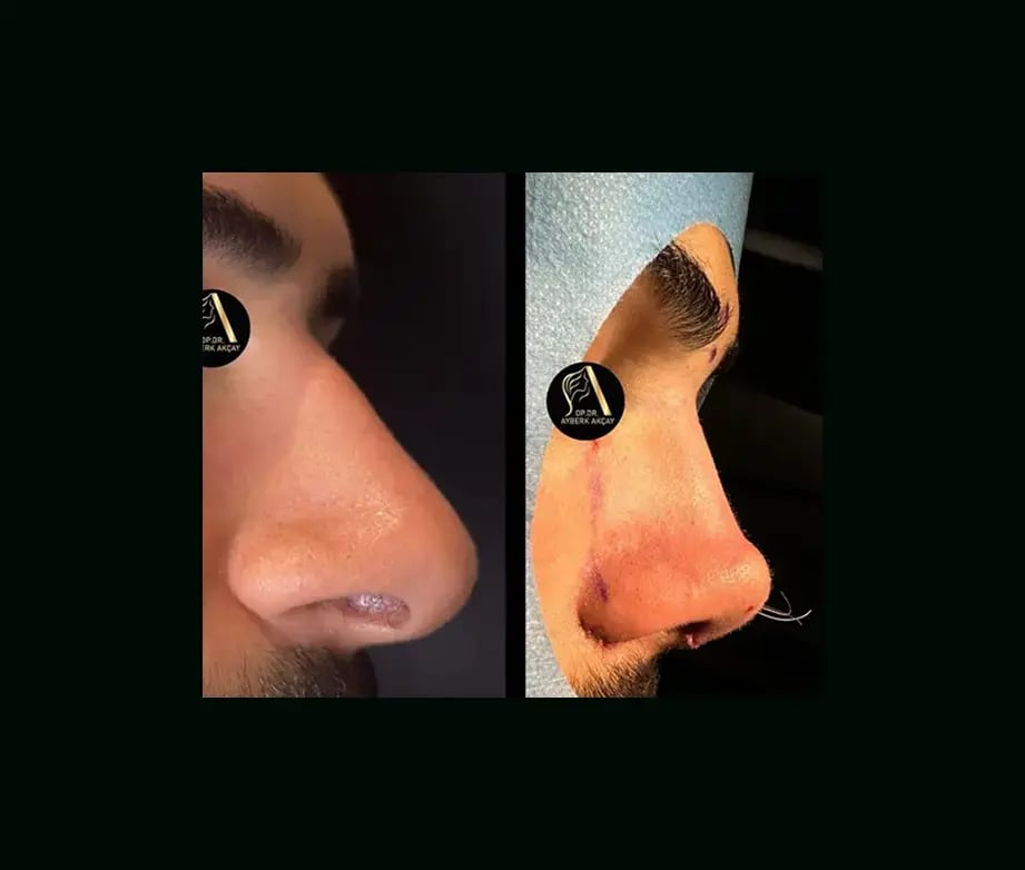 ayberk-akcay-md-rhinoplasty-before-after-2
