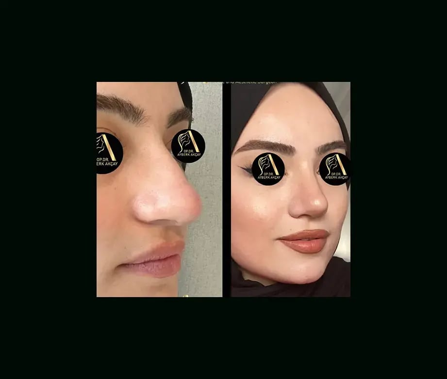 ayberk-akcay-md-rhinoplasty-before-after-3-1
