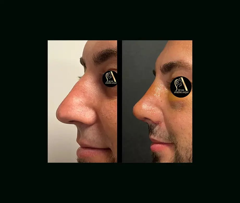ayberk-akcay-md-rhinoplasty-before-after-4-1
