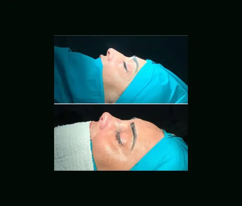 cenk-teker-md-rhinoplasty-before-after-1