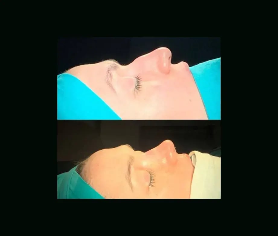 cenk-teker-md-rhinoplasty-before-after-10