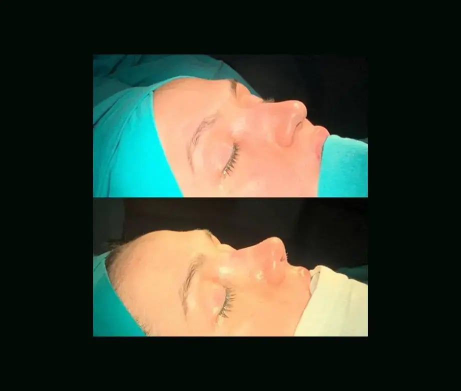 cenk-teker-md-rhinoplasty-before-after-11