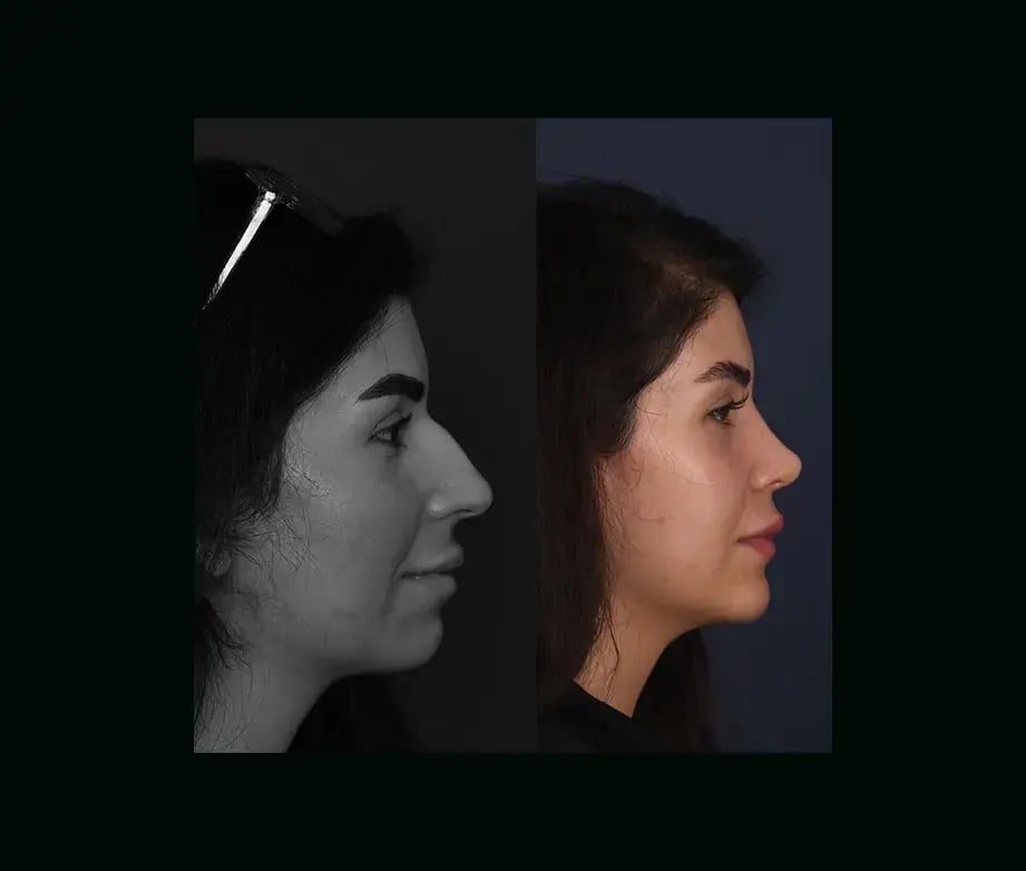 cenk-teker-md-rhinoplasty-before-after-12