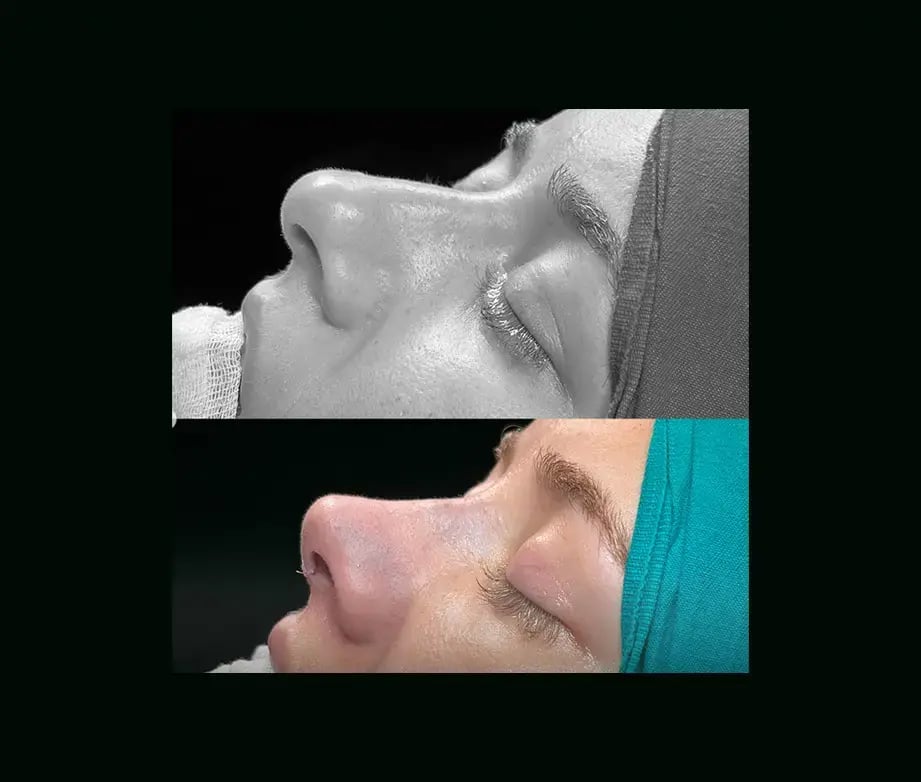 cenk-teker-md-rhinoplasty-before-after-13