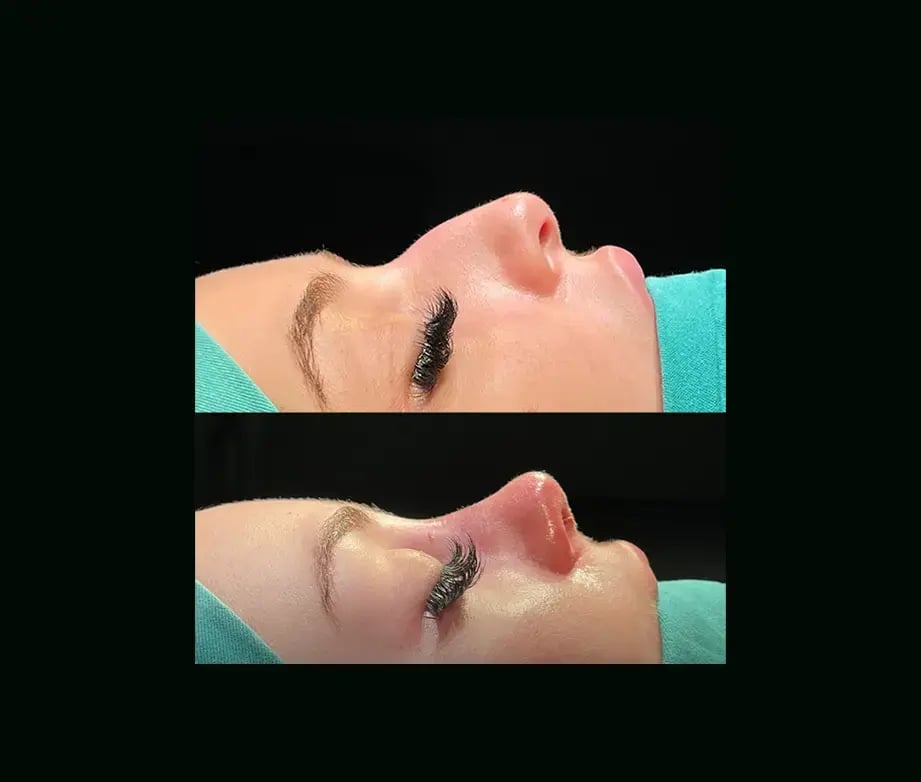 cenk-teker-md-rhinoplasty-before-after-15