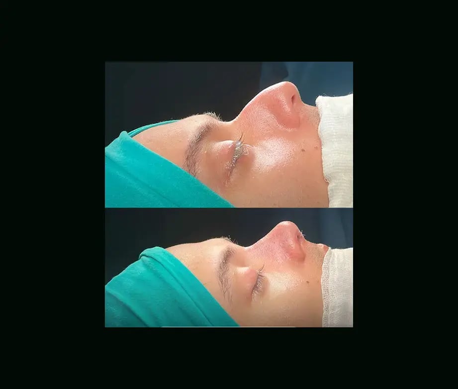cenk-teker-md-rhinoplasty-before-after-16