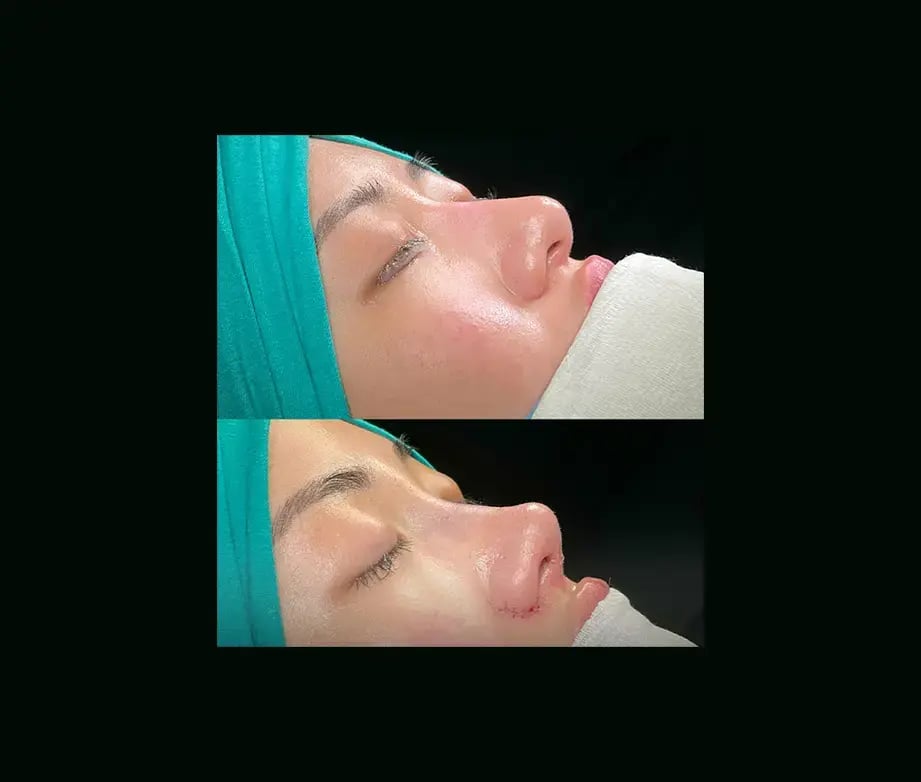 cenk-teker-md-rhinoplasty-before-after-17