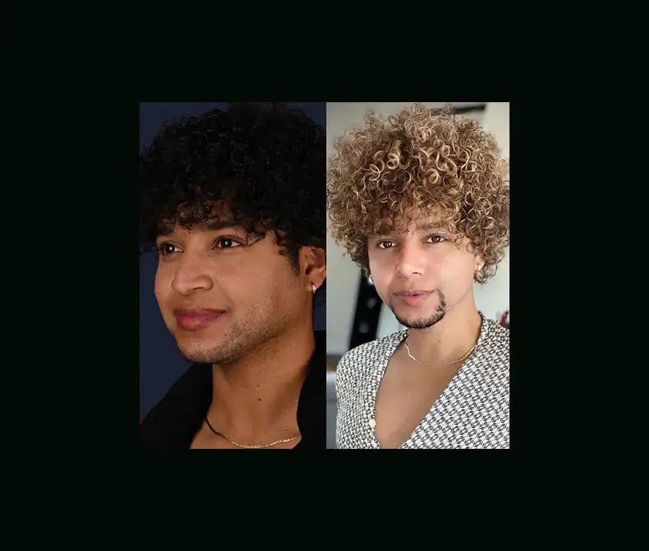 cenk-teker-md-rhinoplasty-before-after-18