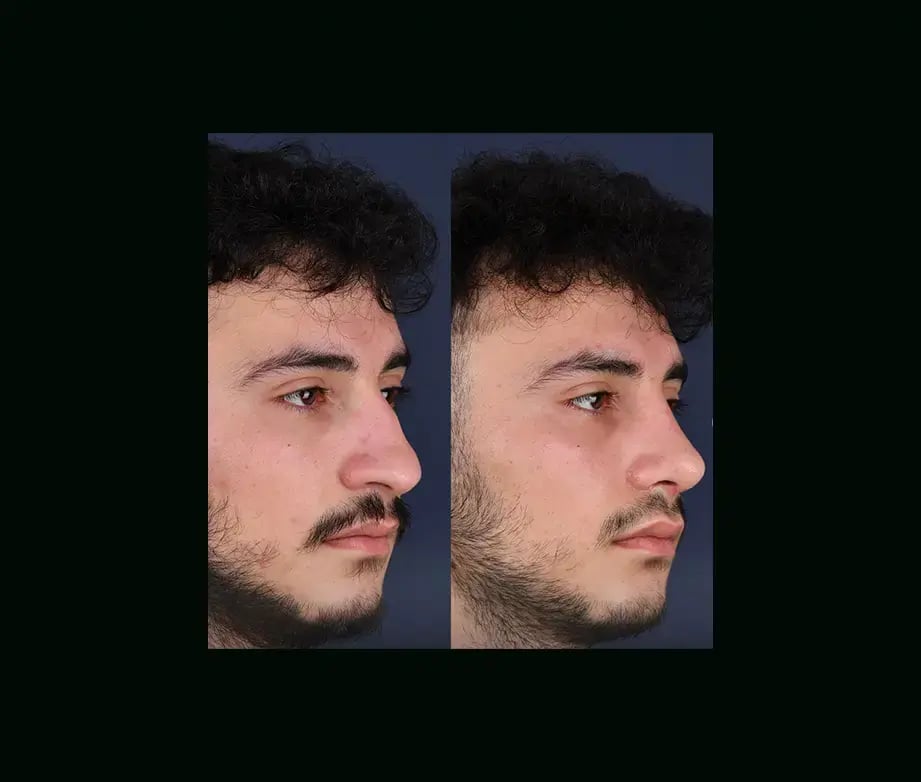 cenk-teker-md-rhinoplasty-before-after-19