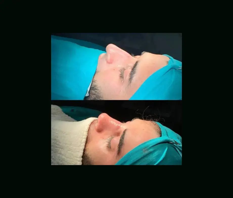 cenk-teker-md-rhinoplasty-before-after-2