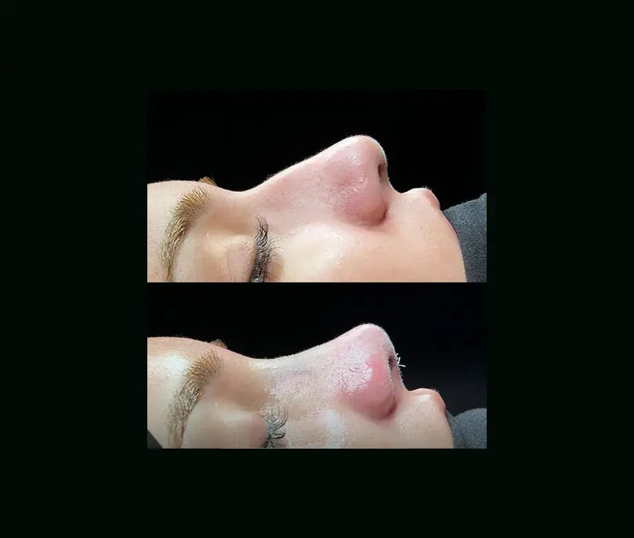 cenk-teker-md-rhinoplasty-before-after-20