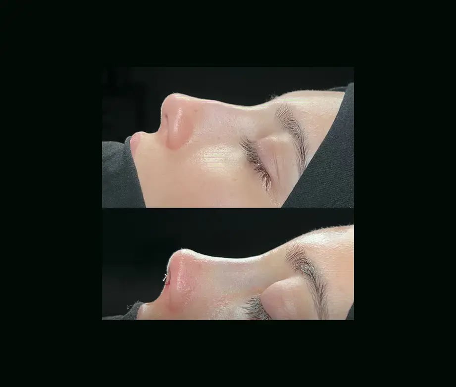 cenk-teker-md-rhinoplasty-before-after-21
