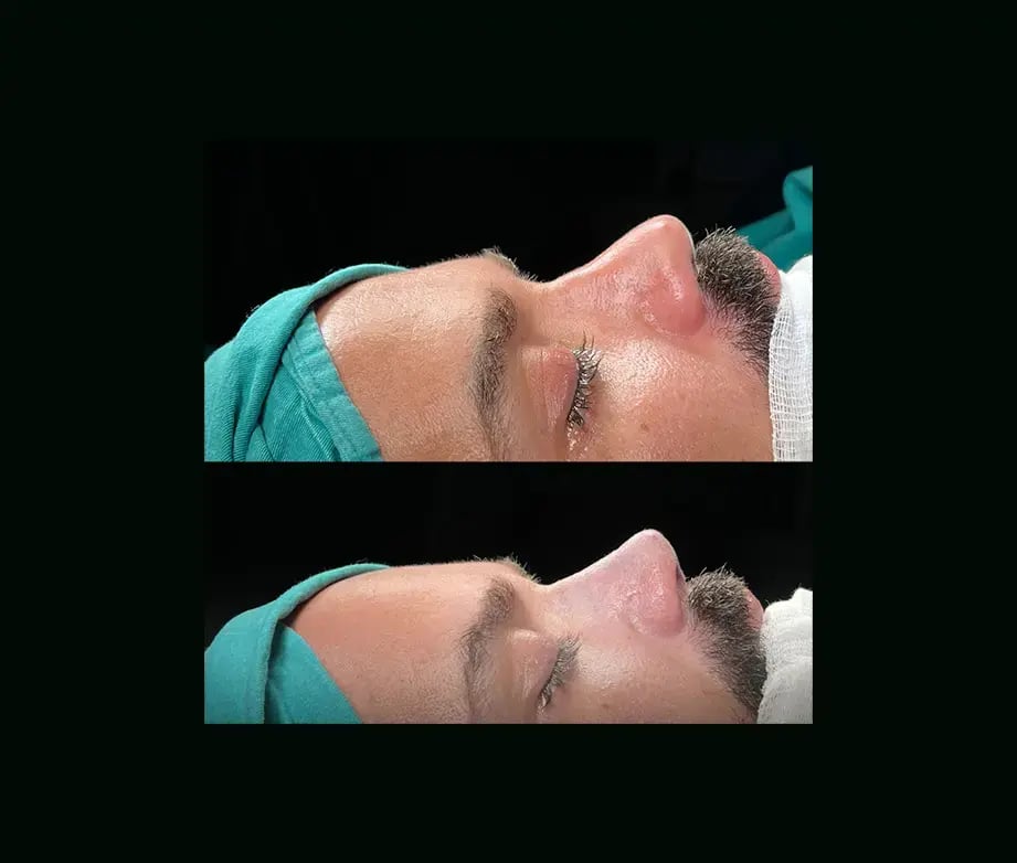 cenk-teker-md-rhinoplasty-before-after-22