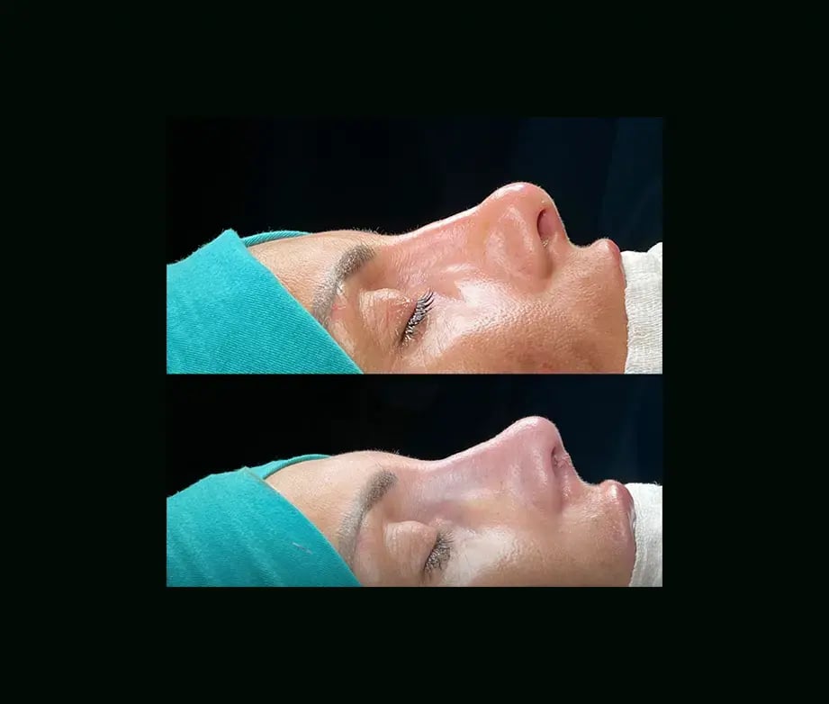 cenk-teker-md-rhinoplasty-before-after-23